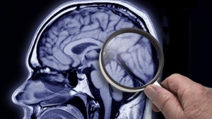 demans-ve-alzheimer-hastaligi-IhXE1fSj.jpg