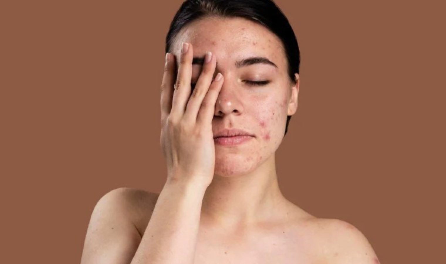 sivilceler-icin-dogal-cozumler-9kFEltRI.jpg