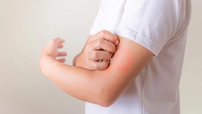 lyme-enfeksiyonu-nedir-ve-nasil-bulasir-Mqgm4rsR.jpg