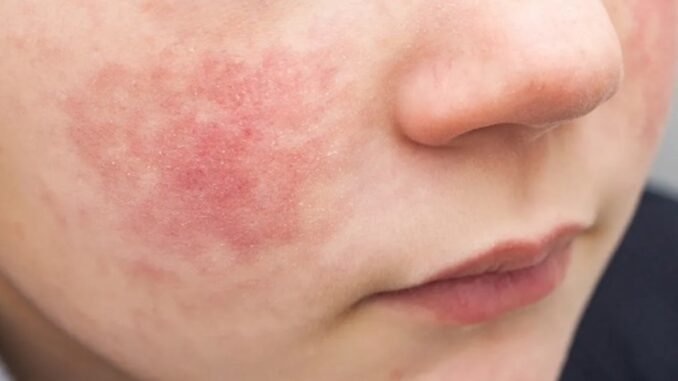 parvovirus-b19-belirtileri-riskleri-ve-onleme-yontemleri-P9VEF4cF.jpg