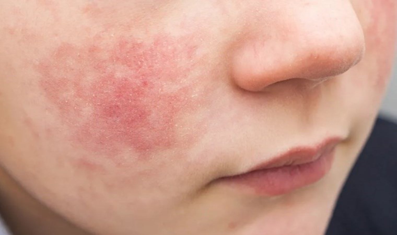 parvovirus-b19-belirtileri-riskleri-ve-onleme-yontemleri-P9VEF4cF.jpg